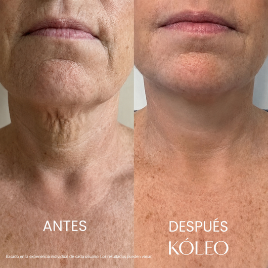 Firmelle™ Lift – Adiós a la Papada y el Cuello Flácido